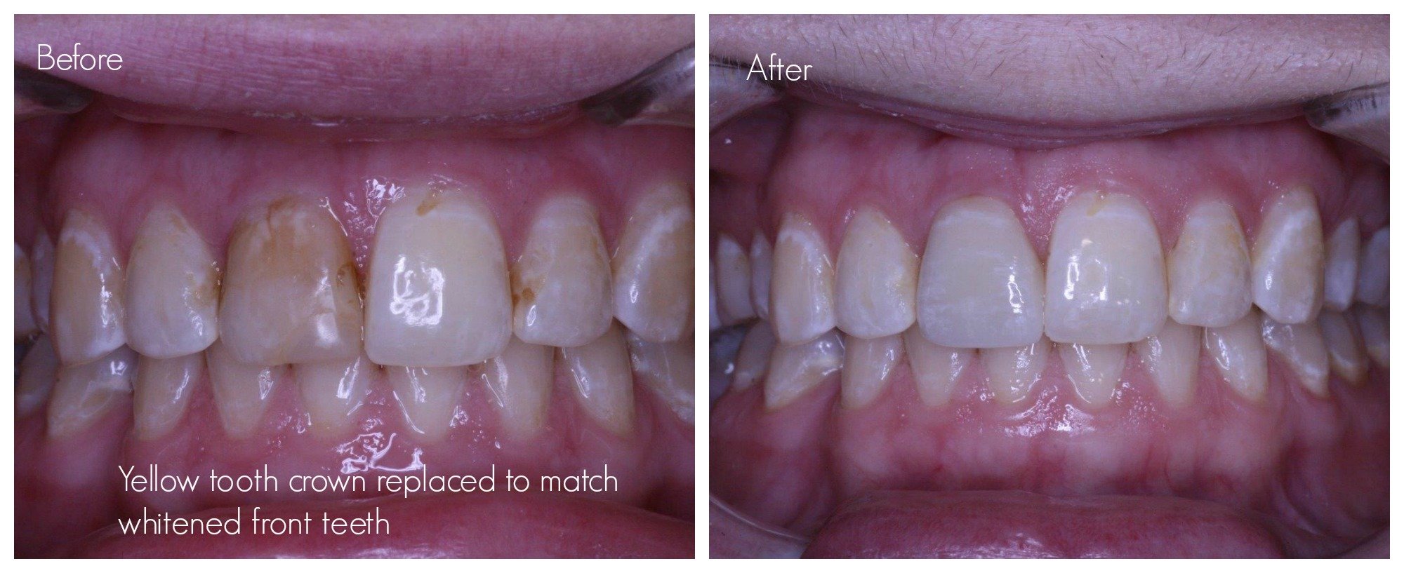 Tooth crown replacement as the colour of tooth crown no longer matches the colour of adjacent teeth