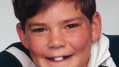 custom fitted mouthguards