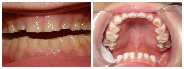 effects of teeth grinding