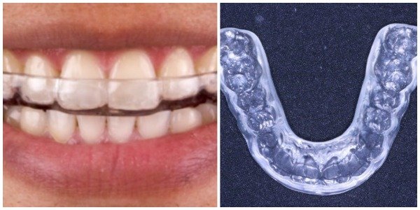 teeth gringding guard