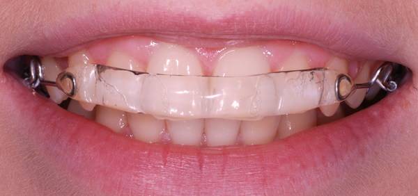 Inman Aligner in your mouth