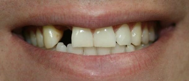tooth implant