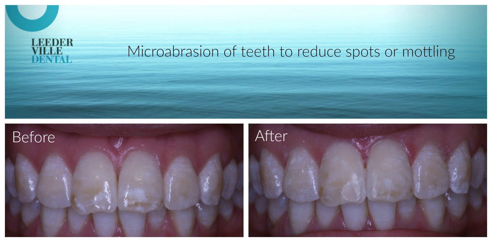 spots can be removed from teeth using microabrasion