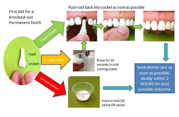 First aid for knocked out permanent teeth