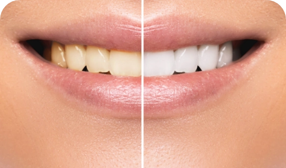 Teeth Whitening Leederville Dental